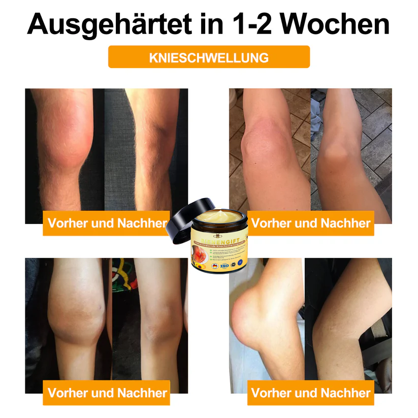 ✅ Offizieller Shop:  Bienengift-Schmerzlinderungs Knochenheilungs Creme 👨‍⚕️(BfArM) zertifiziert(Reduzierung von Gelenkschwellungen, Schmerzen, Steifheit, Rötungen, Wärme, Muskelkater und Gelenkmüdigkeit)